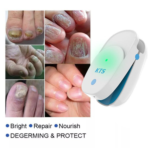 Blanqueamiento Para El Cuidado De Los Pies Con Láser Para Hongos En Las Uñas Por Infrarrojos